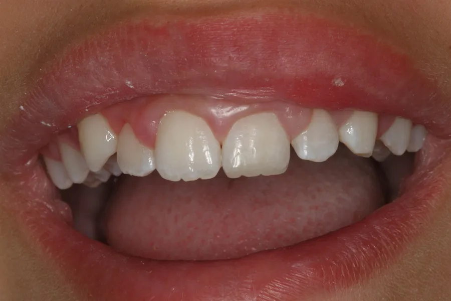 After, Fractured Tooth, Composite Bonding: Isabelle
