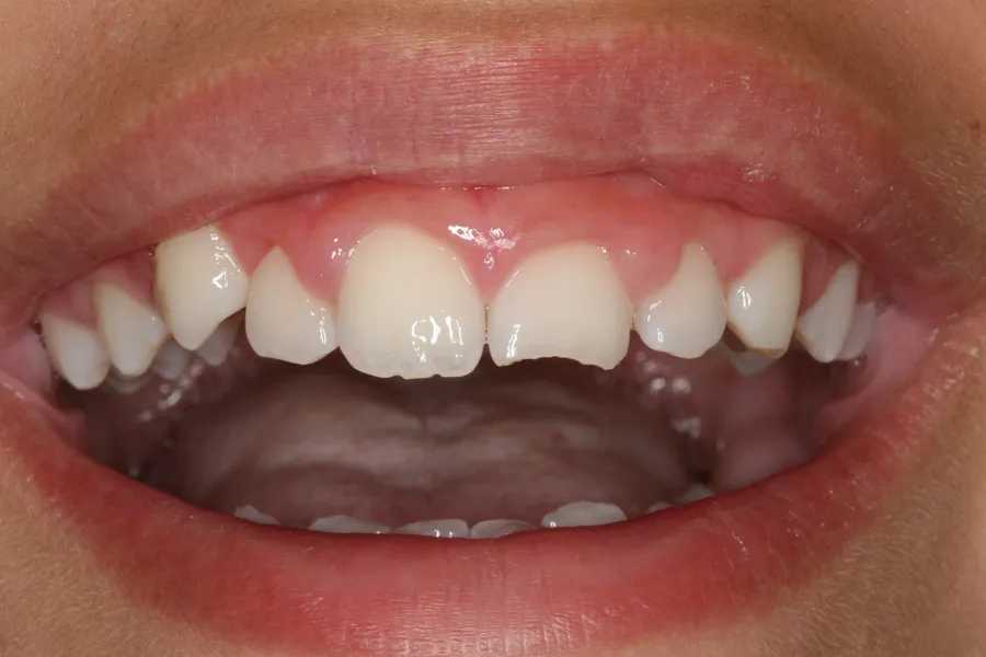 Before, Fractured Tooth, Composite Bonding: Isabelle