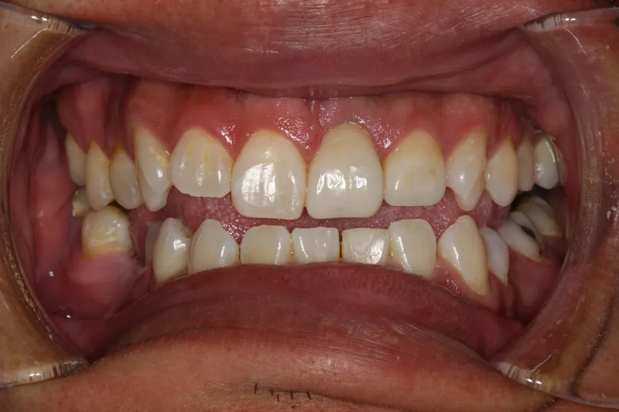 After, Emergency Implant + Crown: Brad