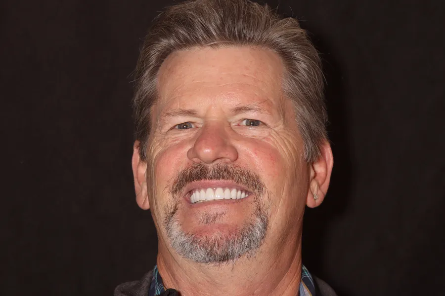 After, Fixed Full-Arch on 4 Implants: Bryan