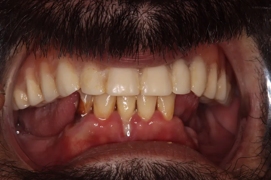 Before, Locator Denture + Fixed Bridges: Danny