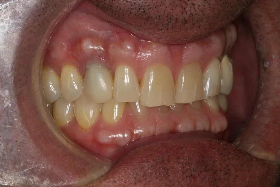 Before, 2 Implants + 4 Veneers: Jeff