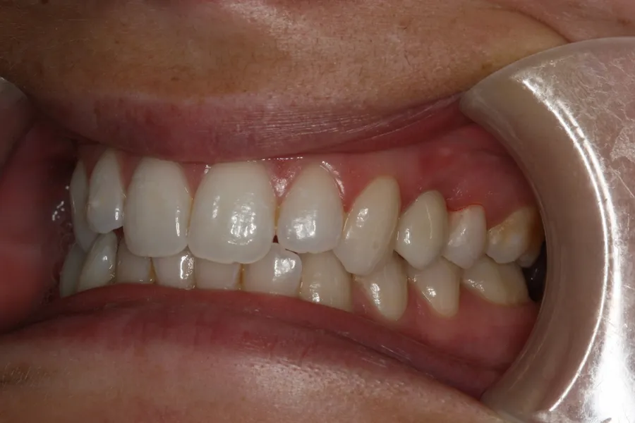 After, Implant + Esthetic Crown: Lizzy