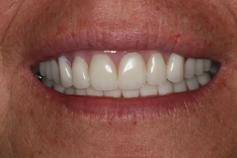 After, Full-Mouth Locator Dentures: Lori