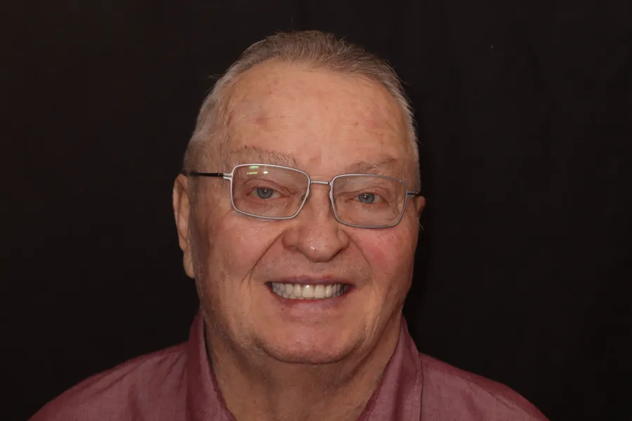 After, Upper & Lower Locator Dentures: Mark