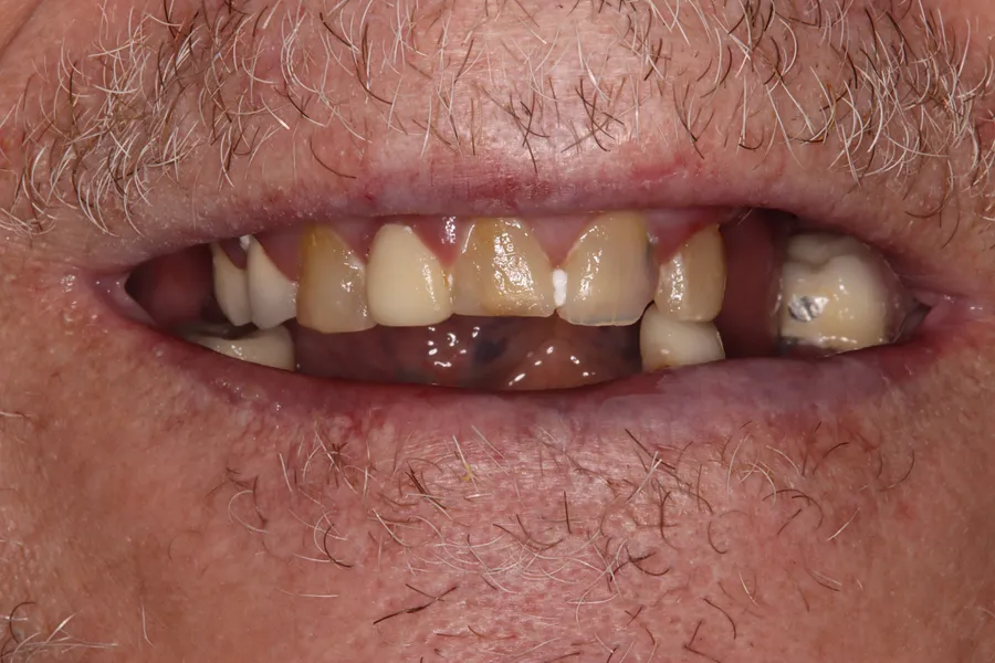 Before (close-up), Upper & Lower Locator Dentures: Mark