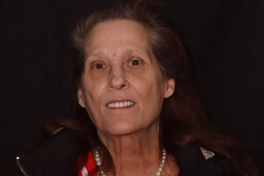 After, Upper Locator Denture: Maurie