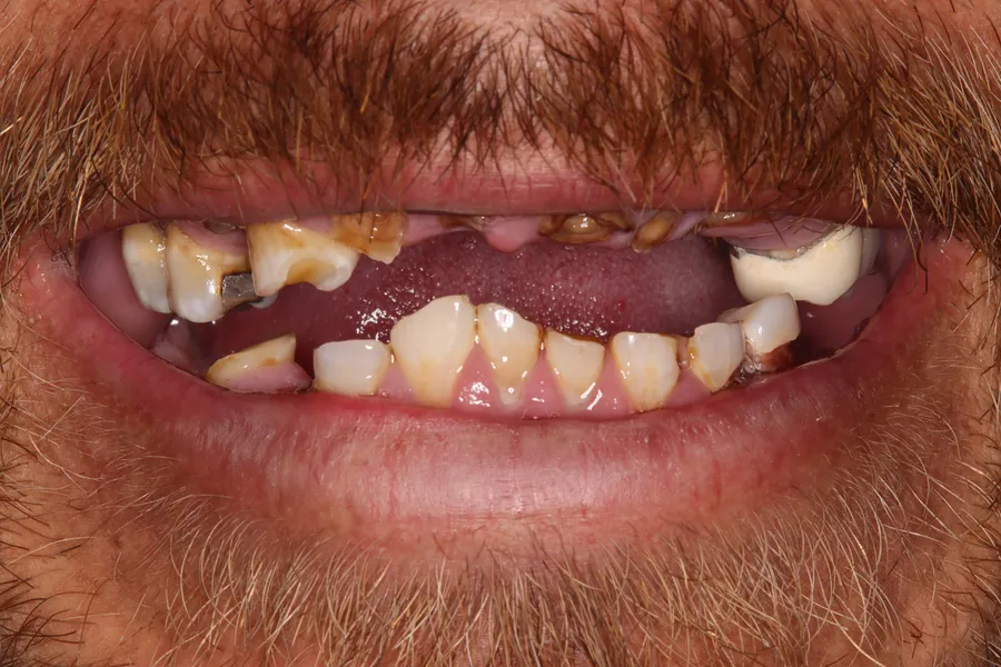 Before (close-up), Full-Mouth Locator Dentures: Miguel