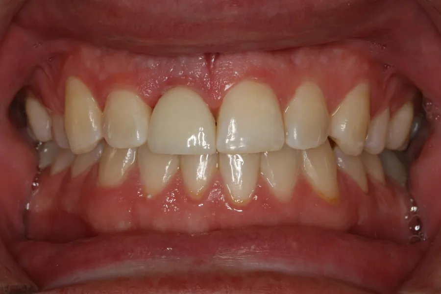 After, Same-Day Implant for a Fractured Tooth: Nick