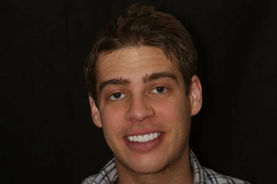After, 8 Minimal-Prep Veneers: Aaron
