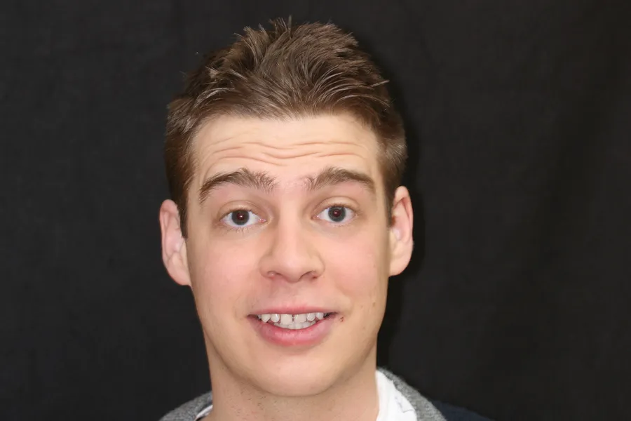 Before, 8 Minimal-Prep Veneers: Aaron