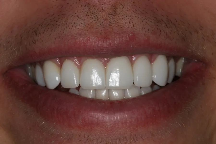 After (close-up), 8 Minimal-Prep Veneers: Aaron