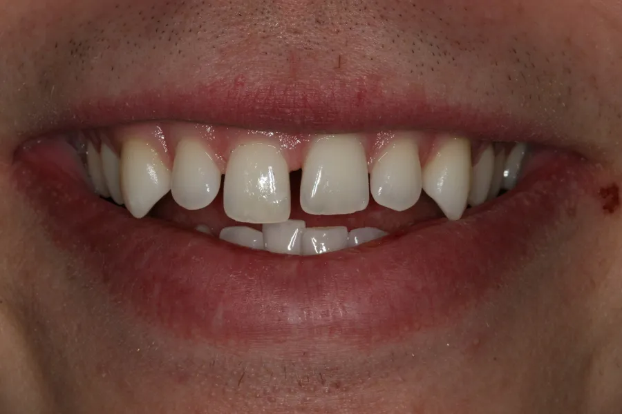 Before (close-up), 8 Minimal-Prep Veneers: Aaron