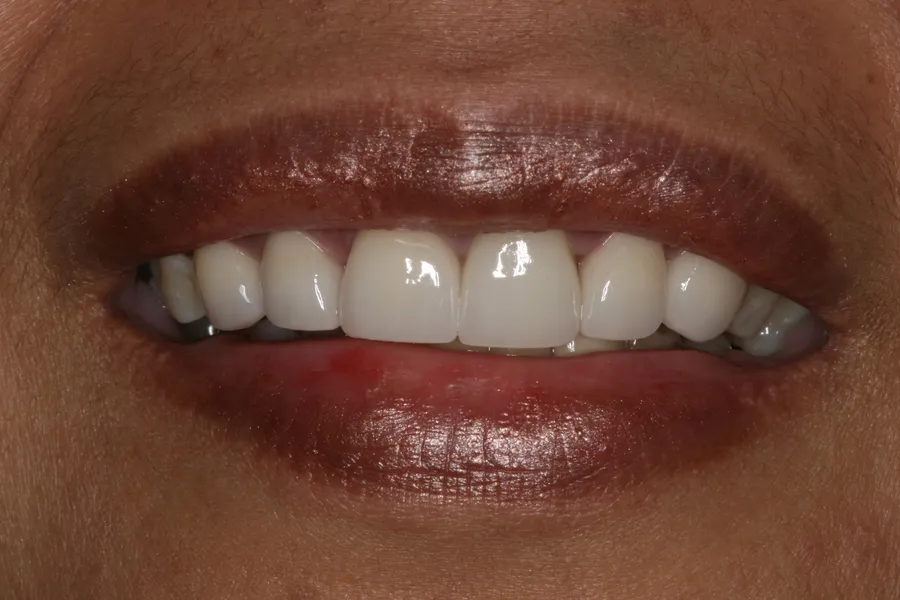 After (close-up), 6 All-Porcelain Esthetic Crowns: Aileen