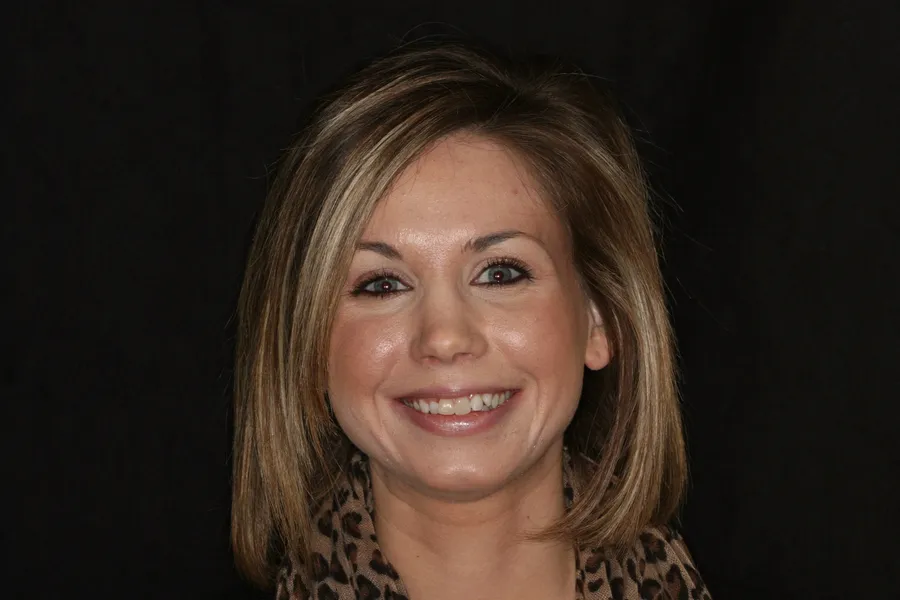 Before, 10 Porcelain Veneers: Ashleigh