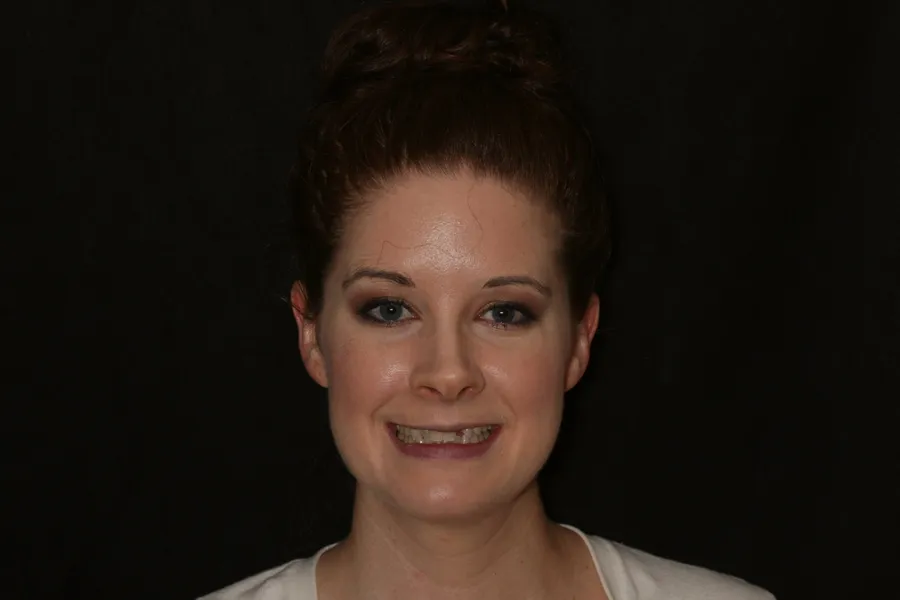 Before, Porcelain Bridge + 3 Veneers: Bridgette
