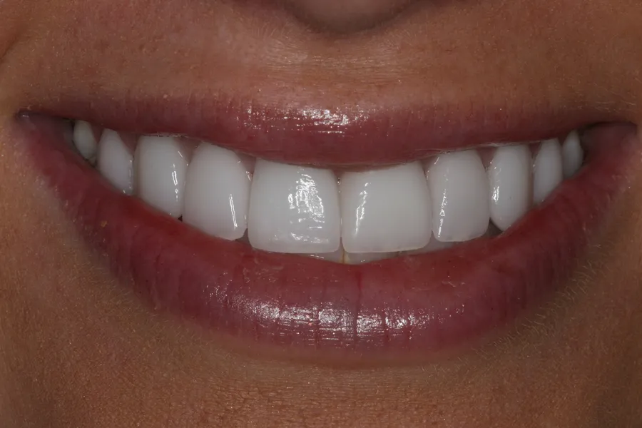 After (close-up), 8 Porcelain Veneers: Brittany