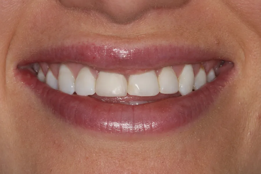 Before (close-up), 8 Porcelain Veneers: Brittany