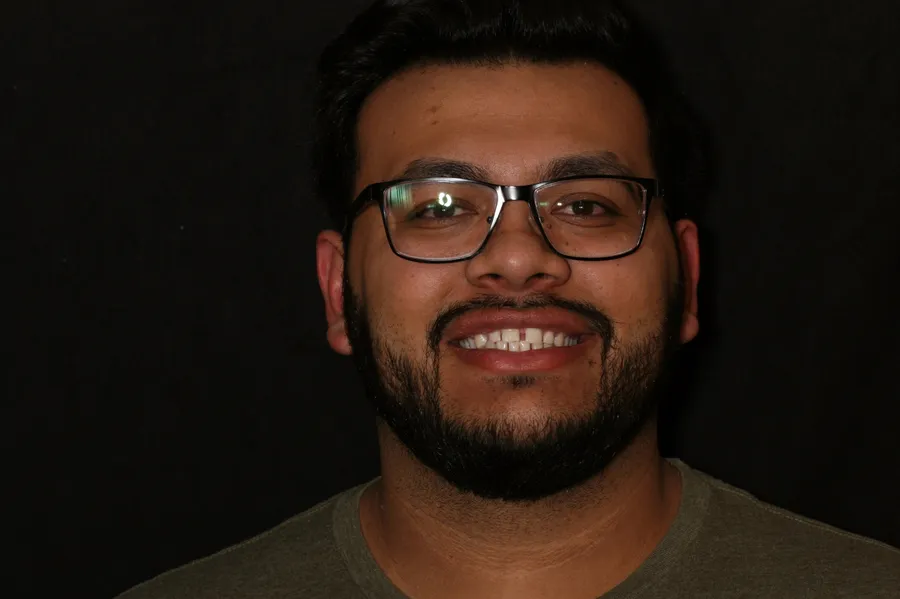 Before, 4 Porcelain Veneers: David