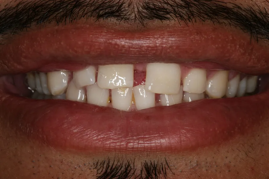 Before (close-up), 4 Porcelain Veneers: David