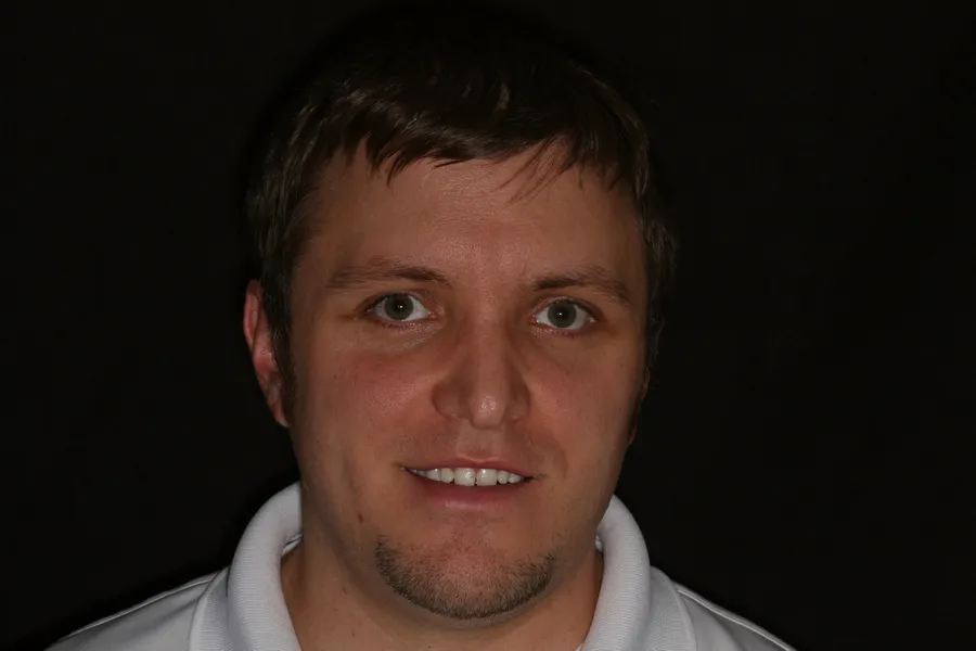 Before, 4 Porcelain Veneers: Dennis