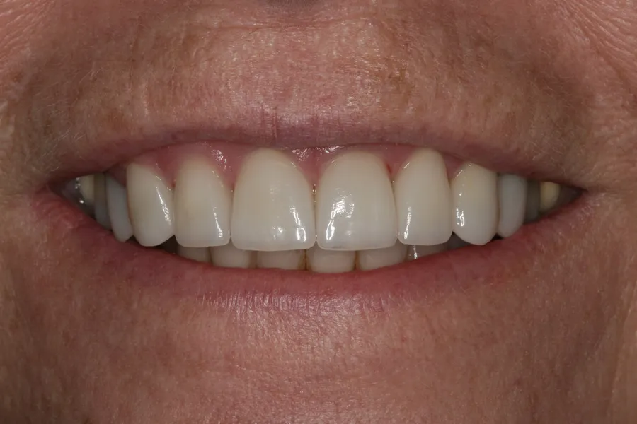 After (close-up), 8 Porcelain Veneers: Diane