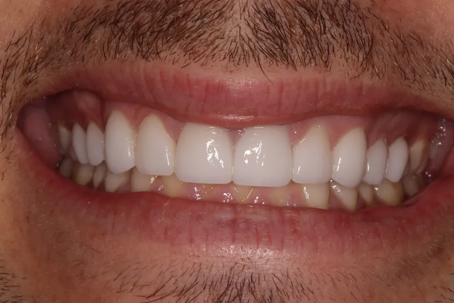 After (close-up), 8 Veneers + 2 Esthetic Crowns: Eric