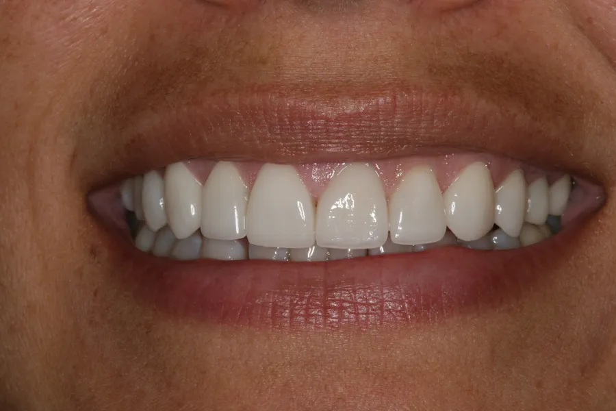 After (close-up), 8 Porcelain Veneers: Janelle
