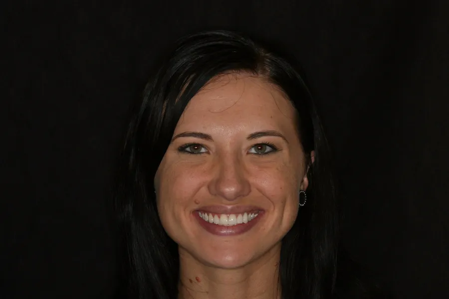 After, 6 Porcelain Veneers: Kristy