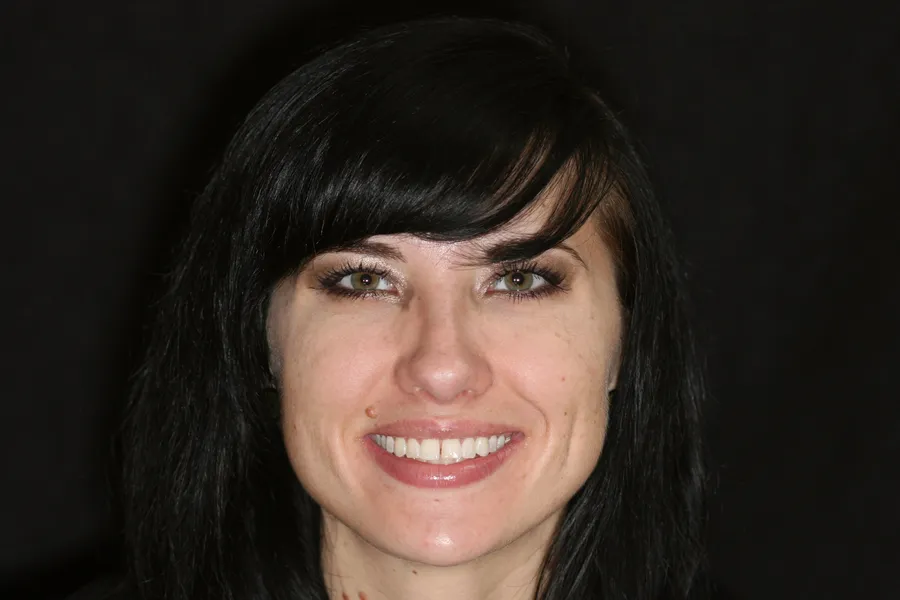 Before, 6 Porcelain Veneers: Kristy