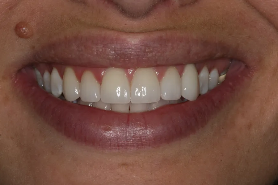 After (close-up), 6 Porcelain Veneers: Kristy