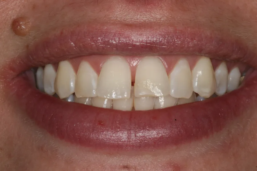 Before (close-up), 6 Porcelain Veneers: Kristy