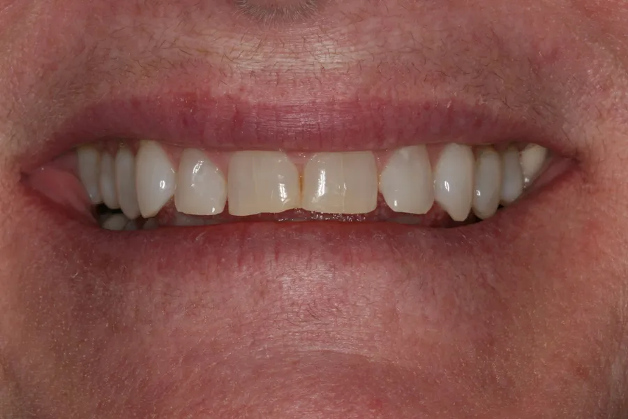 Before (close-up), 10 Porcelain Veneers: Penny