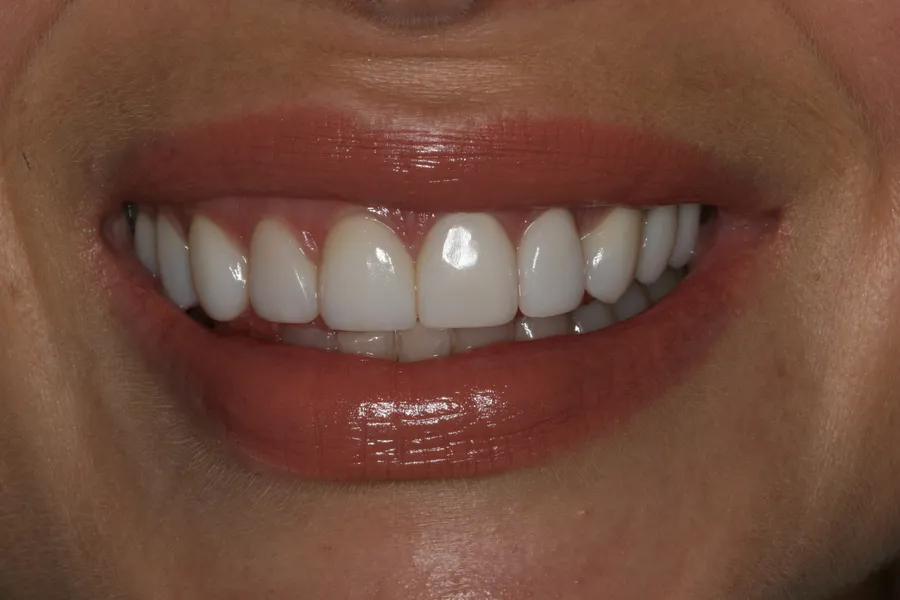 After (close-up), 10 Porcelain Veneers: Saria