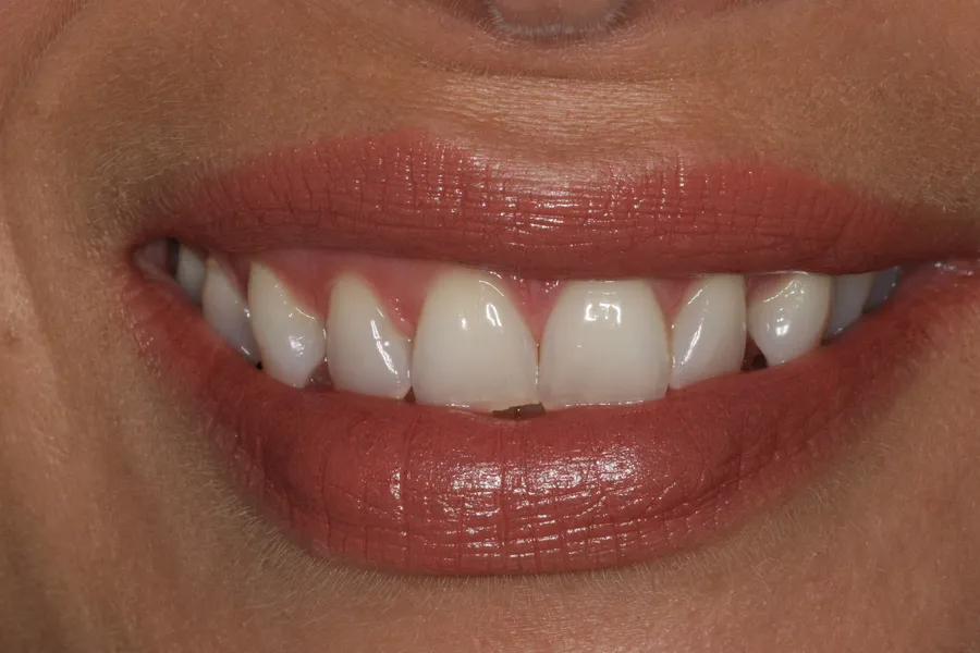 Before (close-up), 10 Porcelain Veneers: Saria