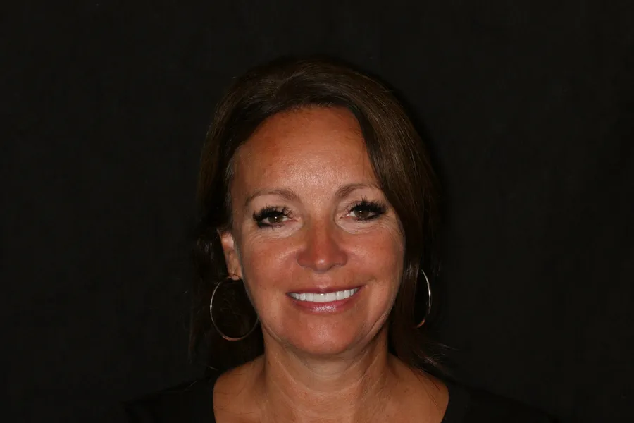 After, 14 Porcelain Veneers: Sharon