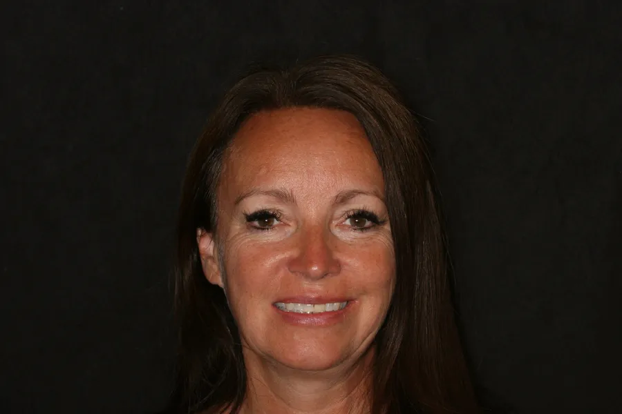 Before, 14 Porcelain Veneers: Sharon