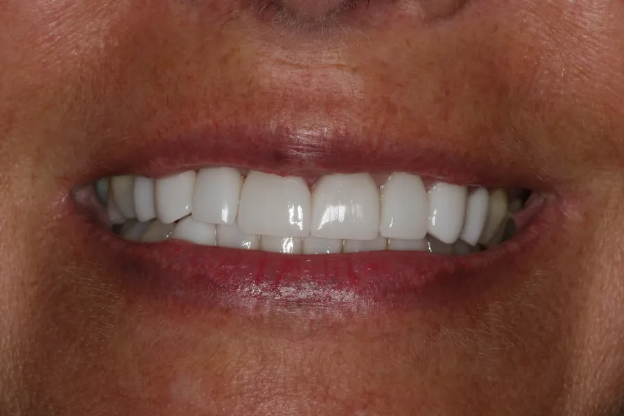 After (close-up), 14 Porcelain Veneers: Sharon