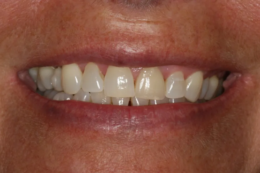 Before (close-up), 14 Porcelain Veneers: Sharon