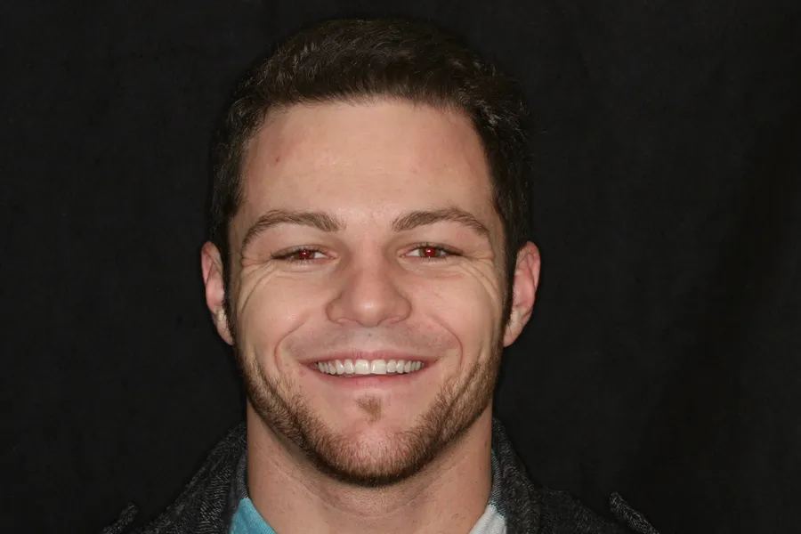 Before, 10 Porcelain Veneers: Zach