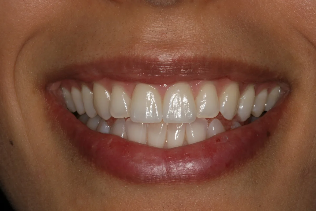 After (close-up), 2 Layered Porcelain Veneers: Anisa