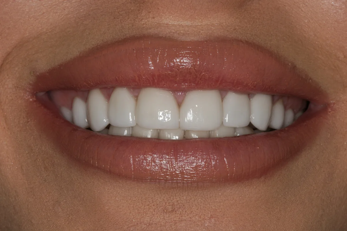 After (close-up), 18 Porcelain Veneers: Ayla