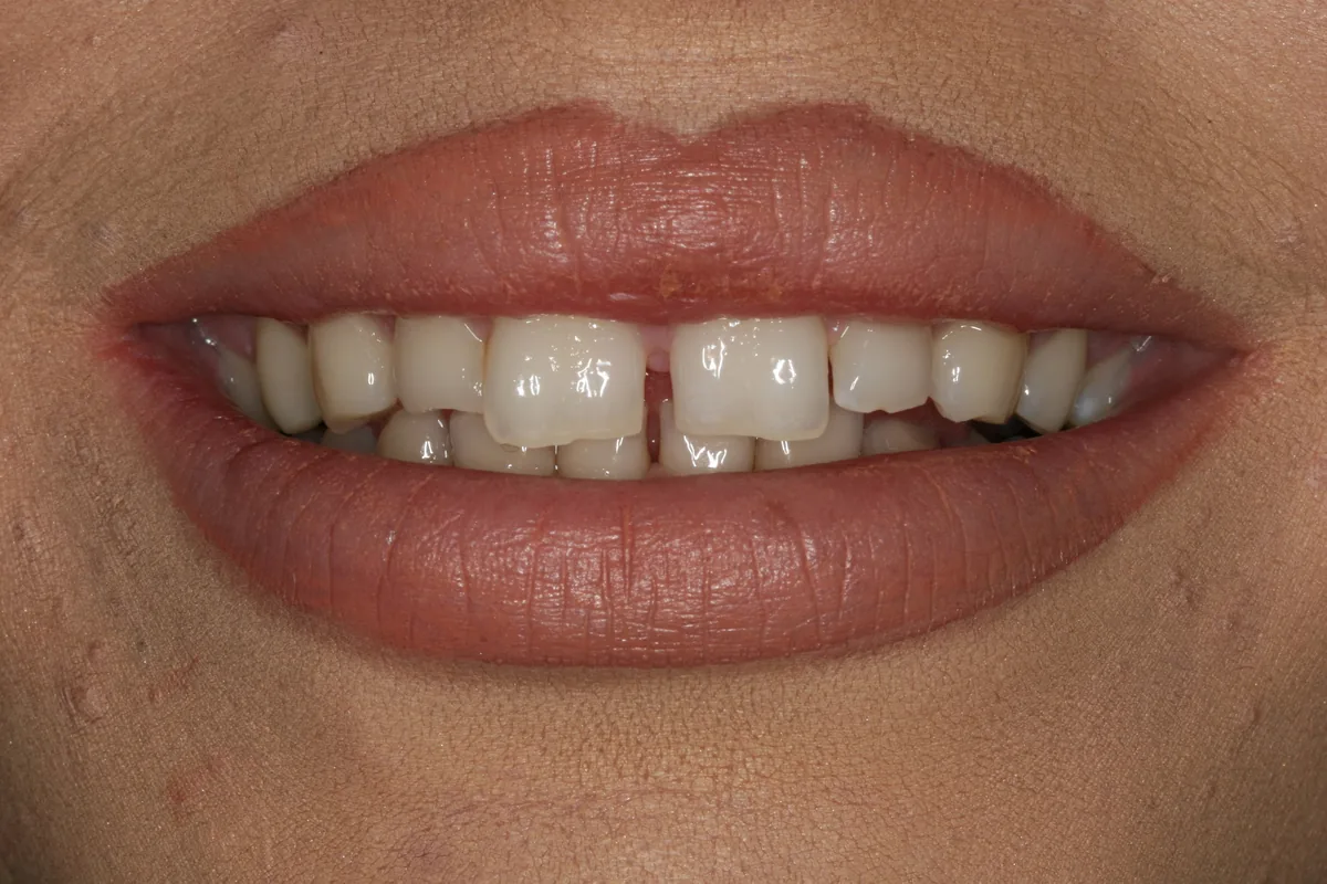 Before (close-up), 18 Porcelain Veneers: Ayla