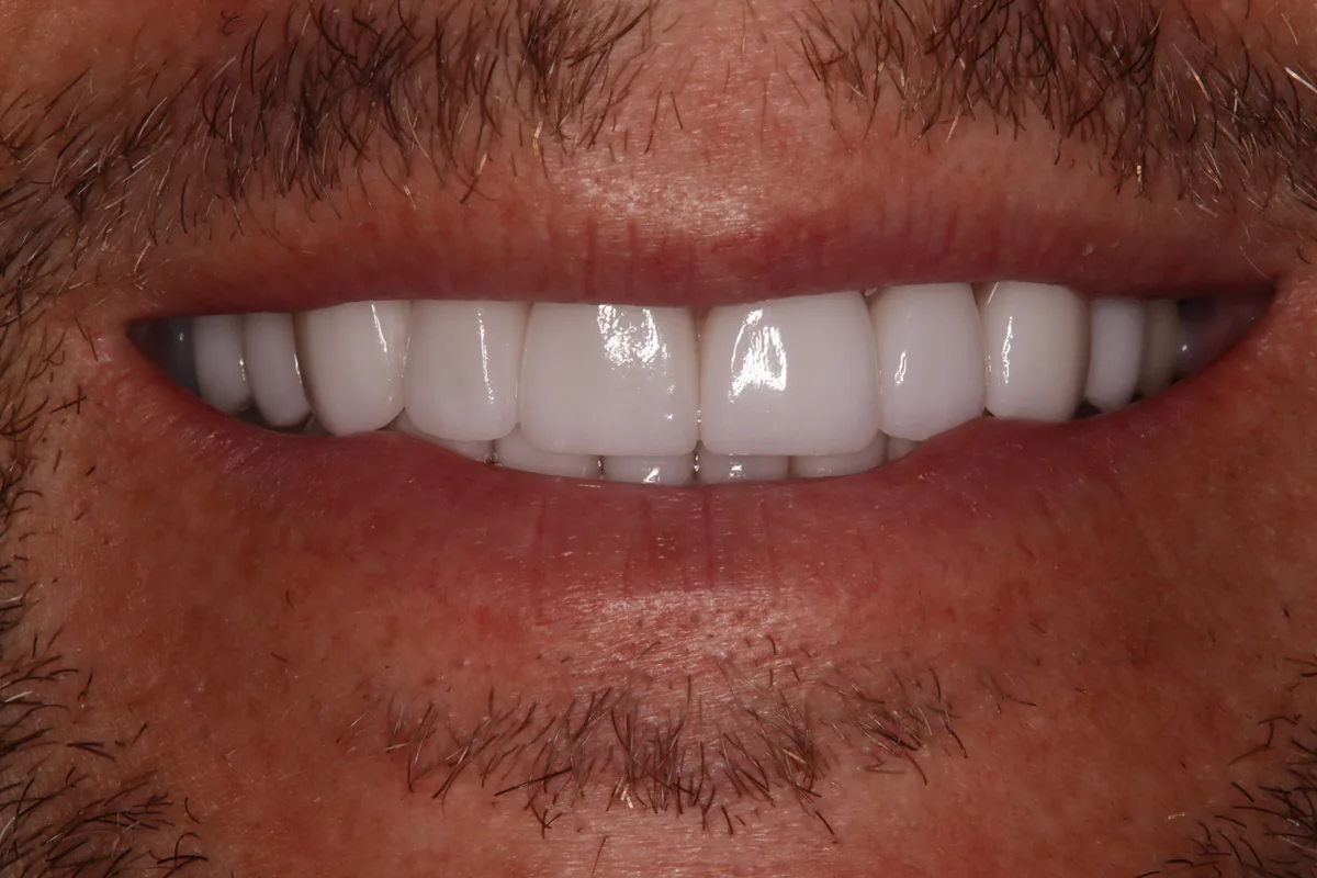 After (close-up), 18 Veneers + 2 Esthetic Crowns: Clint