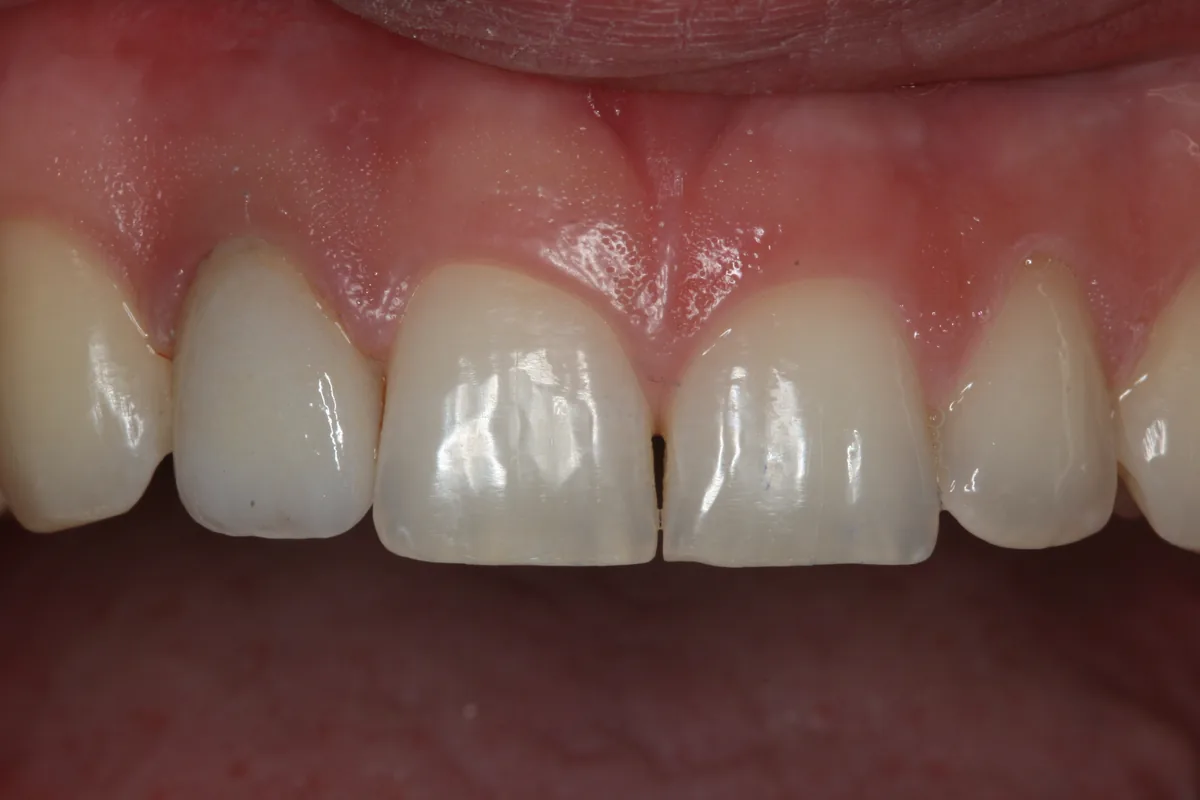 After, 1 Esthetic Porcelain Crown: Cody