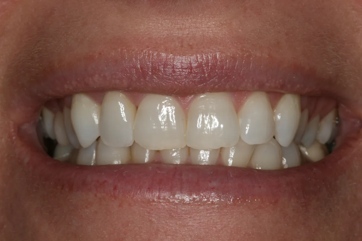 After (close-up), 1 Esthetic Porcelain Crown: Dawn