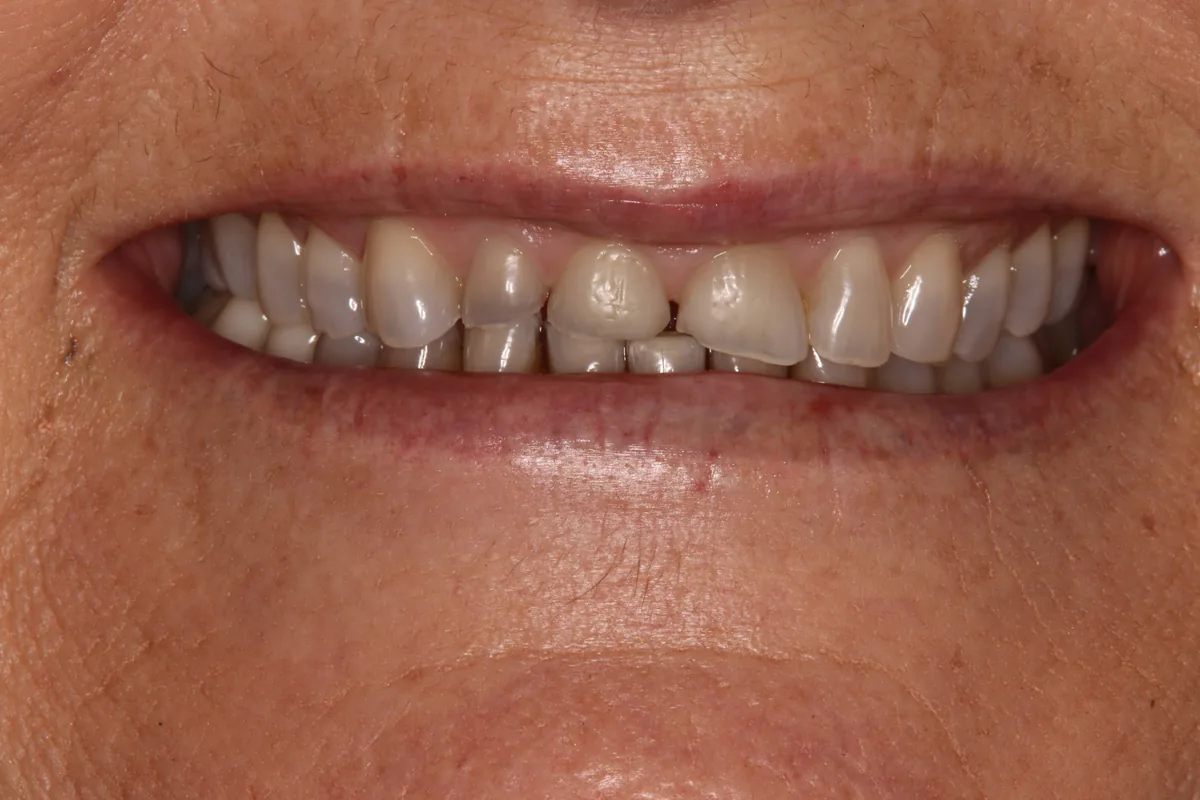 Before (close-up), 8 Esthetic Crowns: Heidi