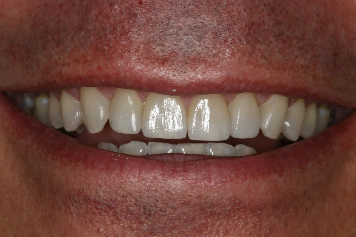 After (close-up), 4 Layered Porcelain Veneers: John
