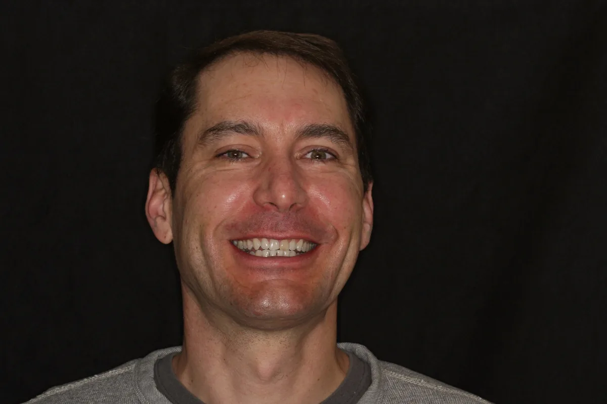 Before, 4 Layered Porcelain Veneers: John