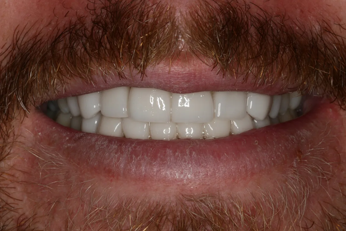 After (close-up), 16 Porcelain Veneers: Jon